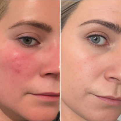 LED Infrared Therapy Mask with Remote