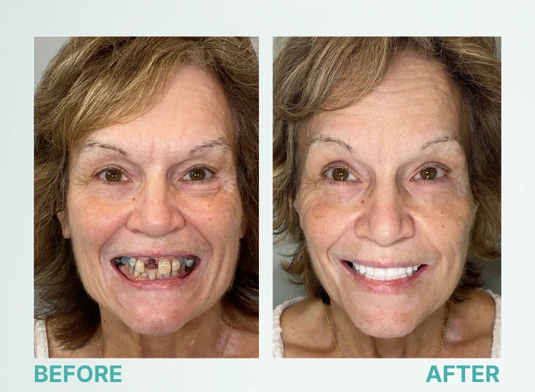 Natural Smile Full Denture Set (Upper & Lower)